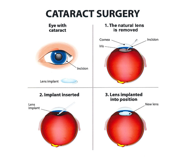 IOL Cataracts Surgery West Palm, FL